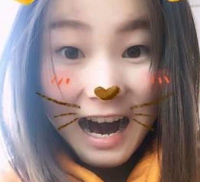 重庆超雅超声波双眼皮，朋友们都说我变漂亮了很多呢287