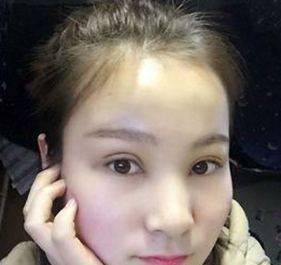 重庆超雅超声波双眼皮，朋友们都说我变漂亮了很多呢287