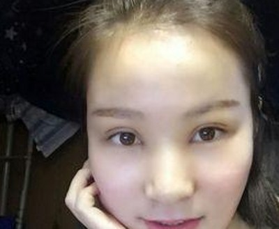 重庆超雅超声波双眼皮，朋友们都说我变漂亮了很多呢287