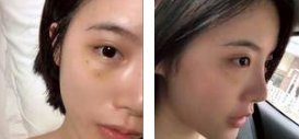 重庆超雅去眼袋手术非常得棒!! 重庆超雅去眼袋手术非常得棒!!