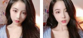重庆超雅去眼袋手术非常得棒!! 重庆超雅去眼袋手术非常得棒!!