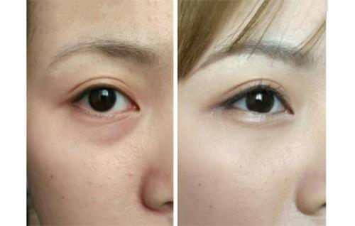 重庆超雅超 声 波去眼袋值得信赖 重庆超雅超 声 波去眼袋值得信赖