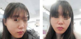 神奇的面部提升术，来看看重庆超雅面部提升案例！666