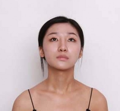 重庆超雅超声波双眼皮，给我了一副完美的双眼皮254