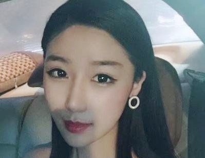 重庆超雅超声波双眼皮，给我了一副完美的双眼皮254