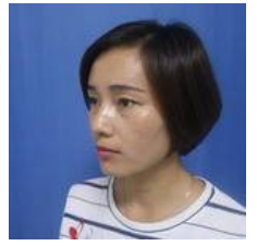 选择了不用开刀的超声波去眼袋,效果不错447 选择了不用开刀的超声波去眼袋,效果不错447