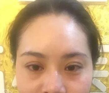 眼袋太大怎么办呢?找不开刀超声波去眼袋啊686 眼袋太大怎么办呢?找不开刀超声波去眼袋啊686