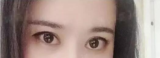 眼袋太大怎么办呢?找不开刀超声波去眼袋啊686 眼袋太大怎么办呢?找不开刀超声波去眼袋啊686