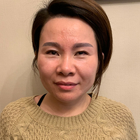 超 声 波去眼袋,和眼袋say拜拜 超 声 波去眼袋,和眼袋say拜拜