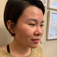 超 声 波去眼袋,和眼袋say拜拜 超 声 波去眼袋,和眼袋say拜拜
