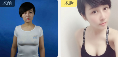 重庆超雅自体脂肪丰胸，让你不用怪招轻松美乳！188