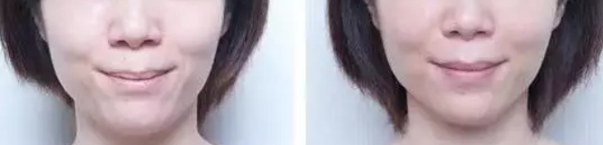重庆超雅得超 声 波瘦脸让你不靠发型靠颜值! 重庆超雅得超 声 波瘦脸让你不靠发型靠颜值!