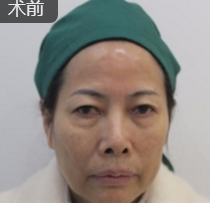 重庆超雅去眼袋手术让你越活越年轻!544 重庆超雅去眼袋手术让你越活越年轻!544