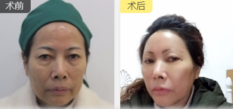 重庆超雅去眼袋手术让你越活越年轻!544 重庆超雅去眼袋手术让你越活越年轻!544