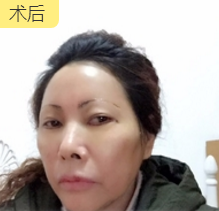 重庆超雅去眼袋手术让你越活越年轻!544 重庆超雅去眼袋手术让你越活越年轻!544