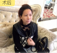 重庆超雅去眼袋手术让你越活越年轻!544 重庆超雅去眼袋手术让你越活越年轻!544