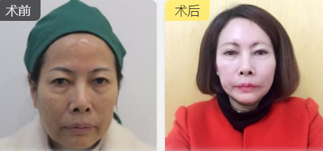 重庆超雅去眼袋手术让你越活越年轻!544 重庆超雅去眼袋手术让你越活越年轻!544