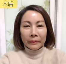 重庆超雅去眼袋手术让你越活越年轻!544 重庆超雅去眼袋手术让你越活越年轻!544