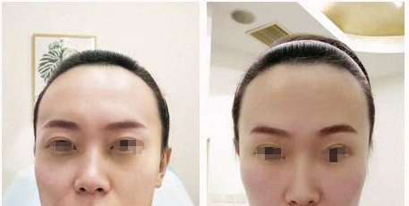 玻尿酸该怎么选？奉上最经典的玻尿酸甄选秘籍！602