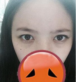重庆超雅超声波去眼袋让这个年如此美丽905 重庆超雅超声波去眼袋让这个年如此美丽905