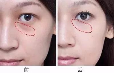 和泪沟针锋相对?用重庆超雅的玻尿酸填充术275 和泪沟针锋相对?用重庆超雅的玻尿酸填充术275