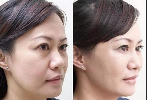 和泪沟针锋相对?用重庆超雅的玻尿酸填充术275 和泪沟针锋相对?用重庆超雅的玻尿酸填充术275