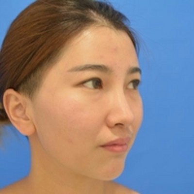 重庆超雅超声波去眼袋，没有眼袋得女人最美丽啊538