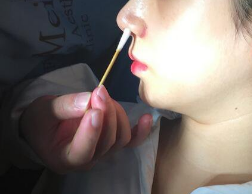 重庆超雅鼻综合整形术→仙气撩人的鼻子620 重庆超雅鼻综合整形术→仙气撩人的鼻子620