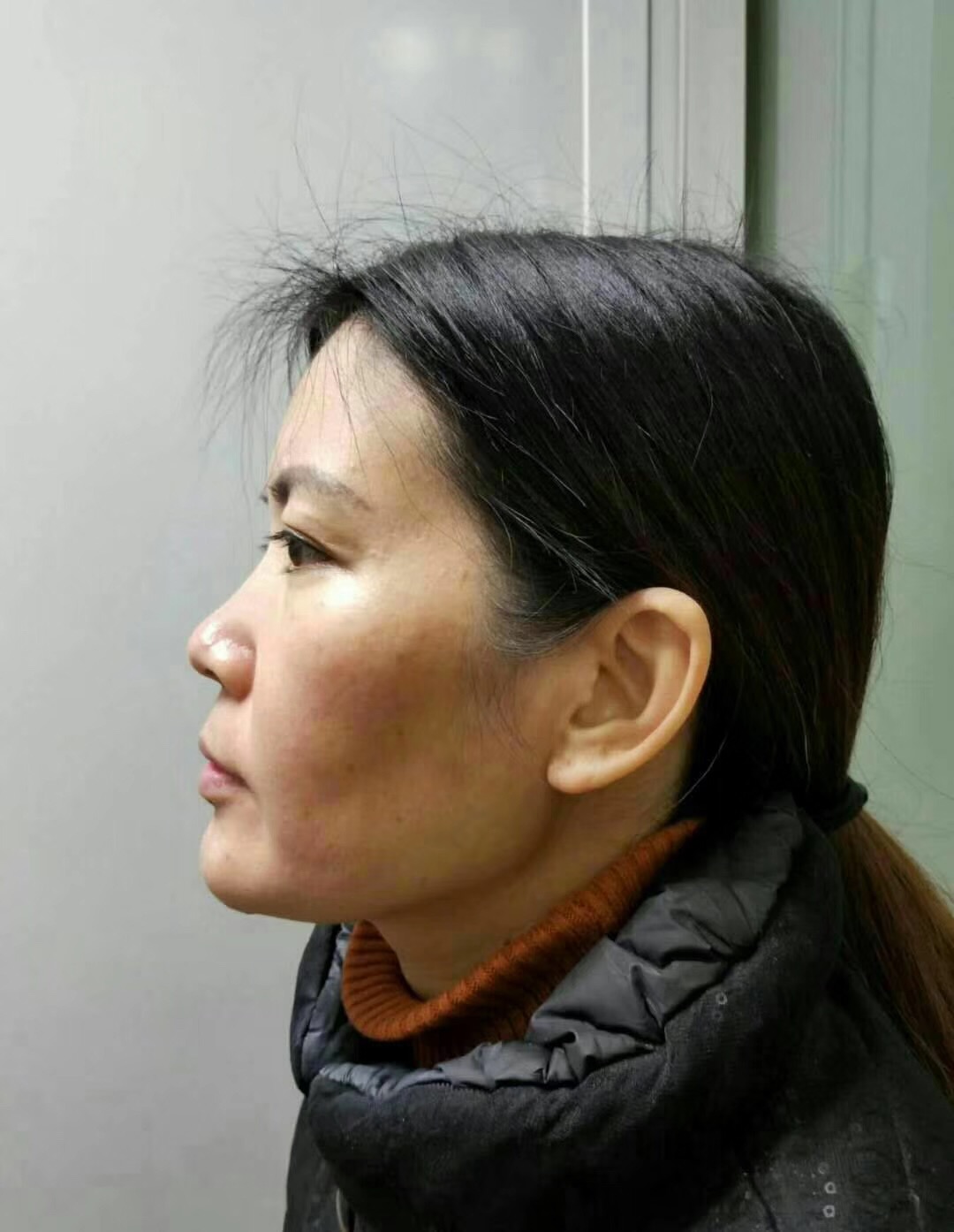 wǒ陪妈妈去超雅做le去眼袋和彭氏童颜术 wǒ陪妈妈去超雅做le去眼袋和彭氏童颜术