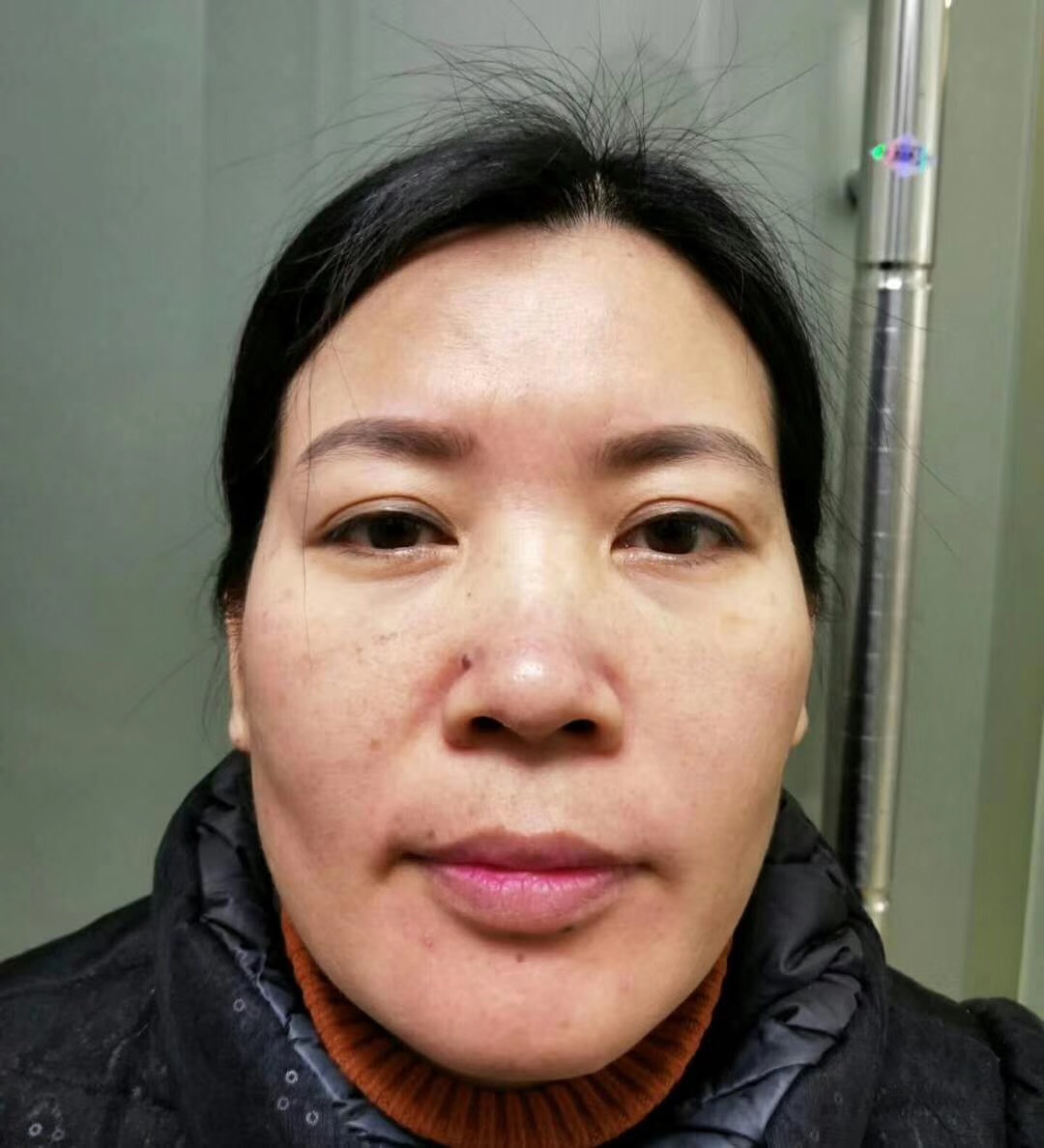 wǒ陪妈妈去超雅做le去眼袋和彭氏童颜术 wǒ陪妈妈去超雅做le去眼袋和彭氏童颜术