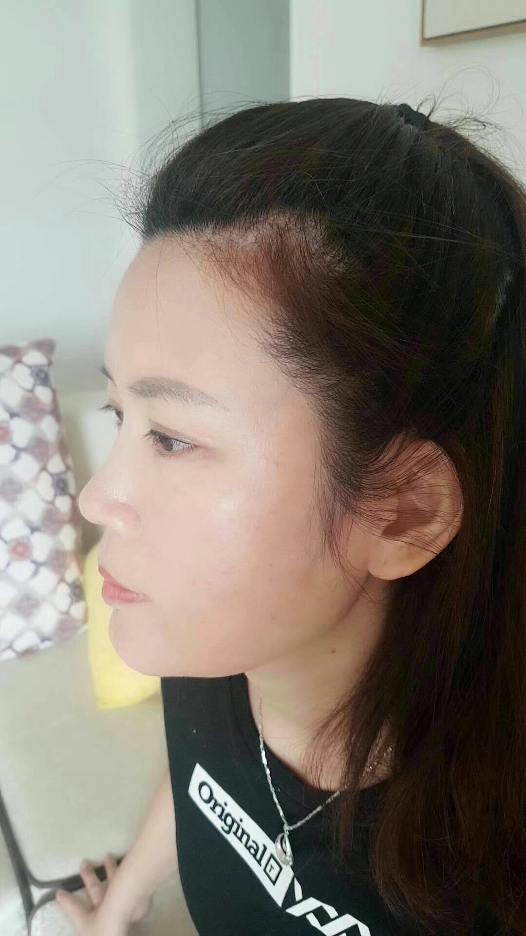 wǒ陪妈妈去超雅做le去眼袋和彭氏童颜术 wǒ陪妈妈去超雅做le去眼袋和彭氏童颜术