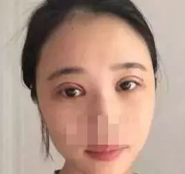 做双眼皮手术失败修复找重庆超雅的梁医生877 做双眼皮手术失败修复找重庆超雅的梁医生877