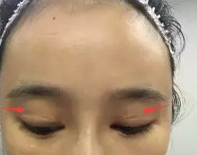 做双眼皮手术失败修复找重庆超雅的梁医生877 做双眼皮手术失败修复找重庆超雅的梁医生877