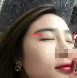 做双眼皮手术失败修复找重庆超雅的梁医生877 做双眼皮手术失败修复找重庆超雅的梁医生877