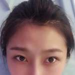 重庆超雅超声波去眼袋,精神抖擞面对明天287 重庆超雅超声波去眼袋,精神抖擞面对明天287