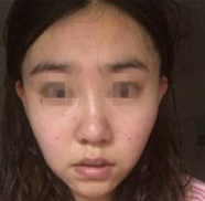 重庆超雅面部提升术,让你可以美美的拍照片459 重庆超雅面部提升术,让你可以美美的拍照片459