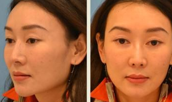 重庆超雅面部提升术让屌丝宅女逆袭成无敌美少女 重庆超雅面部提升术让屌丝宅女逆袭成无敌美少女