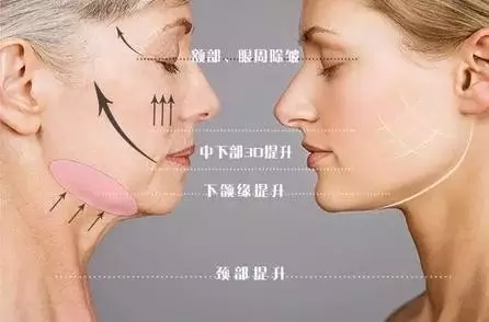 想燃烧青春的激情，来重庆超雅试试面部提升术！177