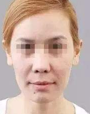 颜值升职双攻略——重庆超雅面部提升术397 颜值升职双攻略——重庆超雅面部提升术397