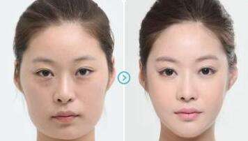 重庆超雅法学教授张女士的面部提升术案例128