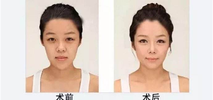 重庆超雅法学教授张女士的面部提升术案例128 重庆超雅法学教授张女士的面部提升术案例128