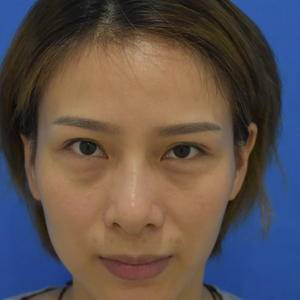 超声波去眼袋终于去掉我大大眼袋635 超声波去眼袋终于去掉我大大眼袋635