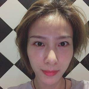超声波去眼袋终于去掉我大大眼袋635 超声波去眼袋终于去掉我大大眼袋635