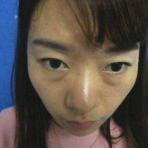 没了烦人的眼袋真的好看,谢谢超声波去眼袋314 没了烦人的眼袋真的好看,谢谢超声波去眼袋314