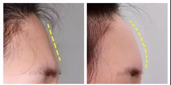 想颜值保鲜,就用重庆超雅得自体脂肪填充术 想颜值保鲜,就用重庆超雅得自体脂肪填充术