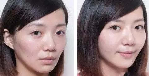 想颜值保鲜,就用重庆超雅得自体脂肪填充术 想颜值保鲜,就用重庆超雅得自体脂肪填充术