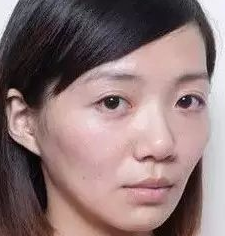 想颜值保鲜,就用重庆超雅得自体脂肪填充术 想颜值保鲜,就用重庆超雅得自体脂肪填充术