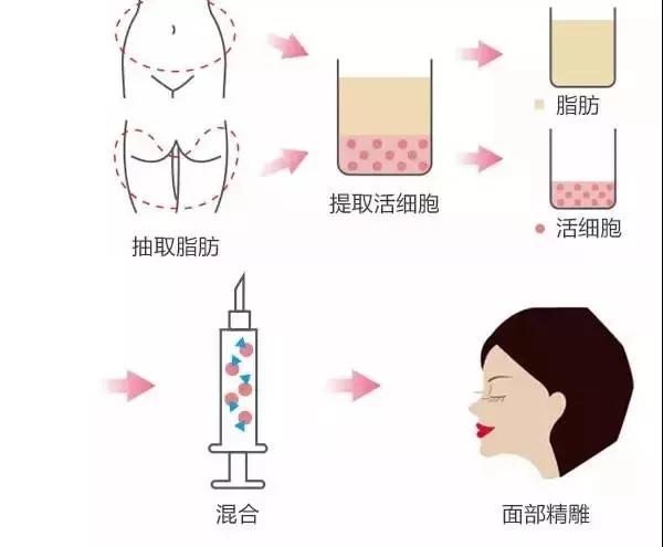 想颜值保鲜,就用重庆超雅得自体脂肪填充术 想颜值保鲜,就用重庆超雅得自体脂肪填充术