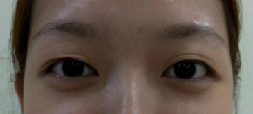 曾经双眼皮手术失败的她，在重庆超雅修复好了！107