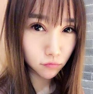 曾经双眼皮手术失败的她，在重庆超雅修复好了！107